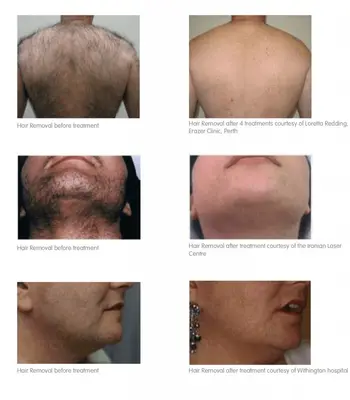 Permanent IPL Laser Hair Removal Epilator for Women with LCD Display photo 3