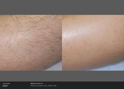 Permanent IPL Laser Hair Removal Epilator for Women with LCD Display photo 5