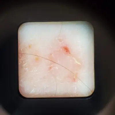 SKIARY Smartphone Dermatoscope Skin Analyzer Microscope photo 6
